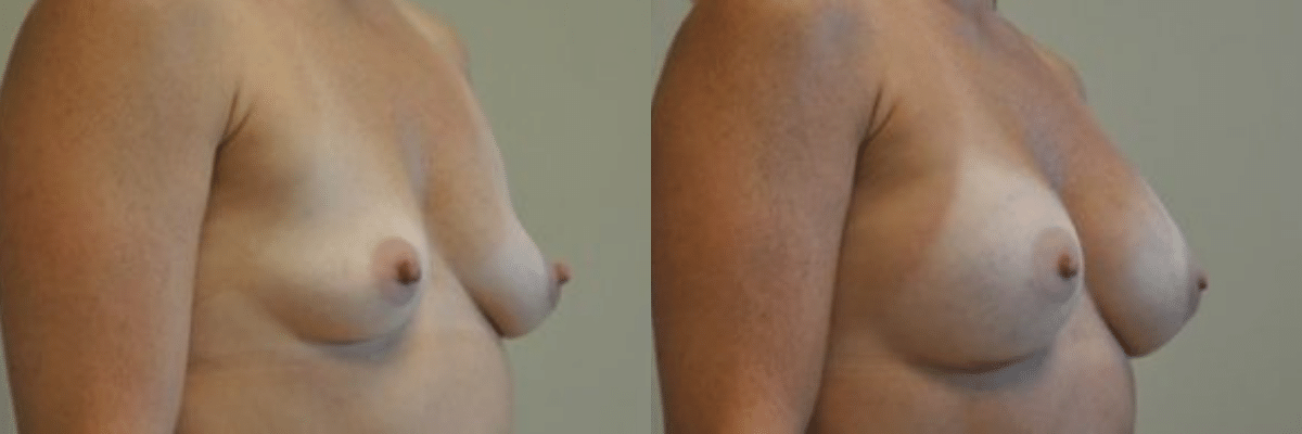 42 year old before and after breast asymmetry and augmentation surgery side view