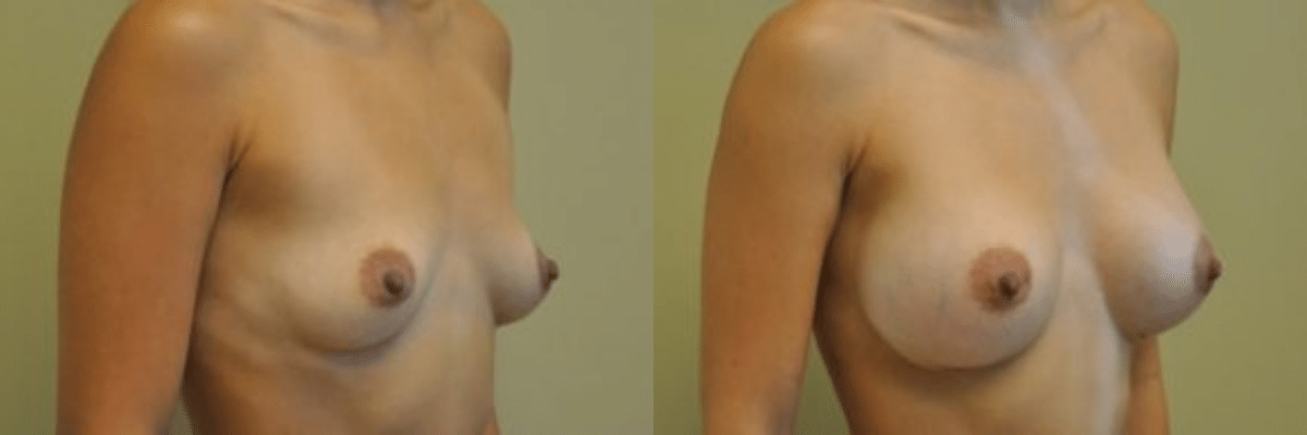 27 year old before and after breast asymmetry and augmentation surgery side view