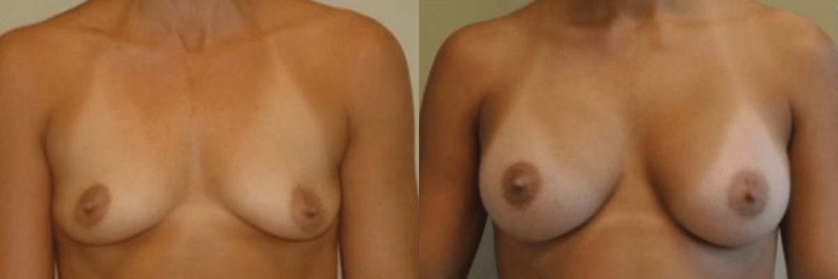 30 year old before and after breast and nipple asymmetry and augmentation surgery front view