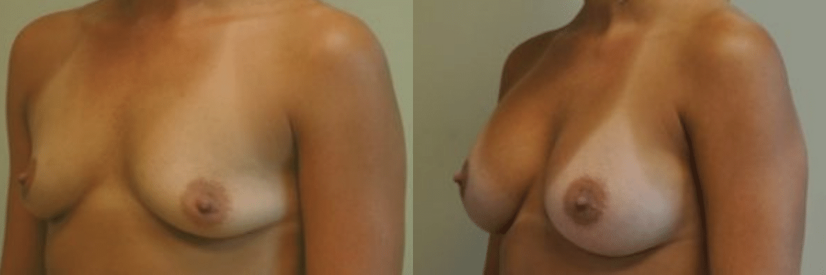 30 year old before and after breast and nipple asymmetry and augmentation surgery side view