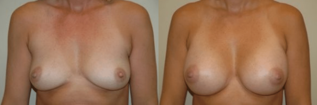 33 year old before and after breast asymmetry and augmentation surgery front view