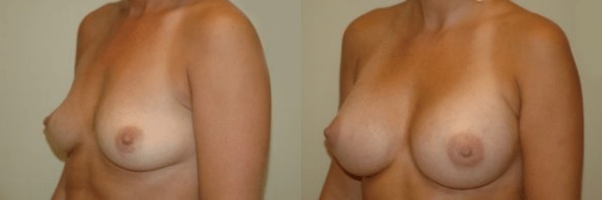 33 year old before and after breast asymmetry and augmentation surgery side view