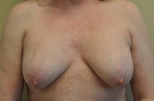 Breast Implant Removal Before and After Photos