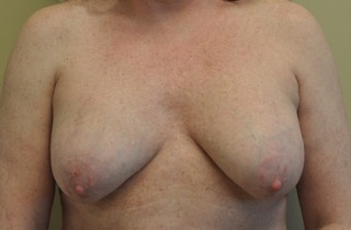 Breast Implant Removal Before and After Photos
