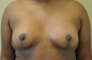 Tubular Breast Before and After Photos