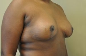 Tubular Breast Before and After Photos
