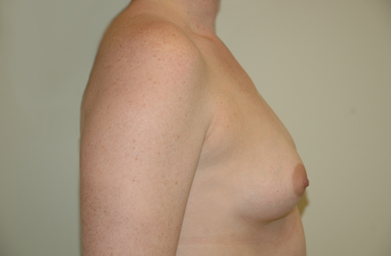 Breast Augmentation Before and After Photos