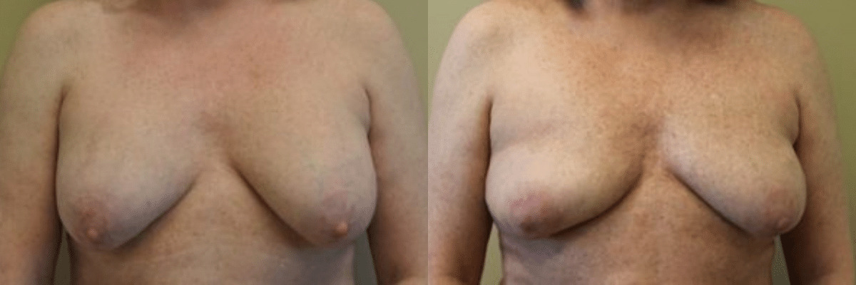 59 year old female before and after breast implant removal front view