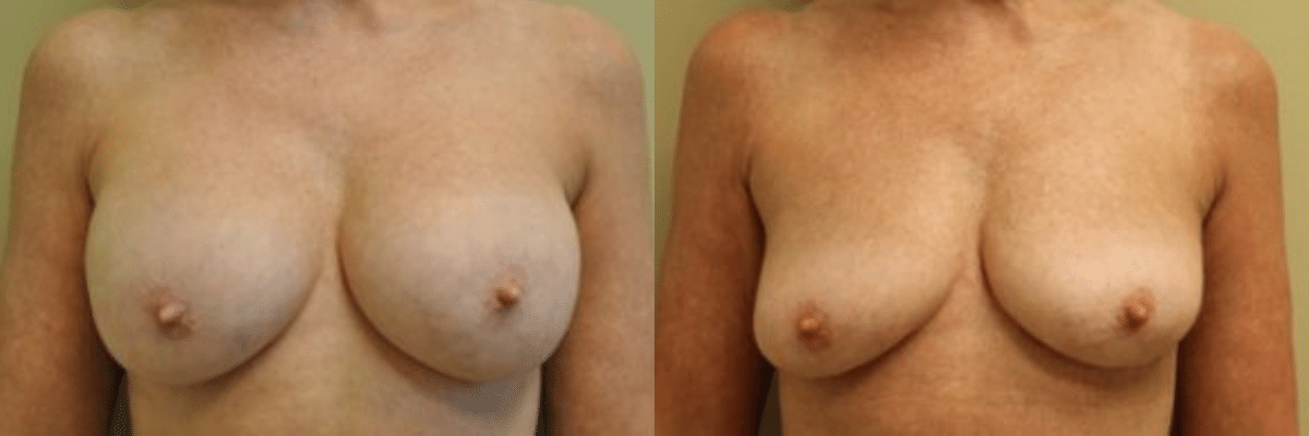 56 year old female before and after breast implant removal front view