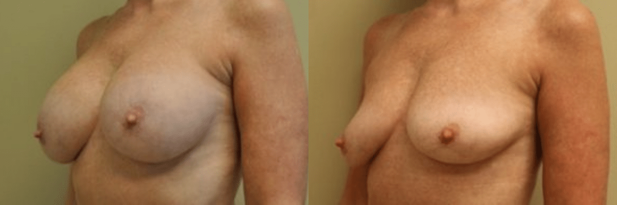 56 year old female before and after breast implant removal side view