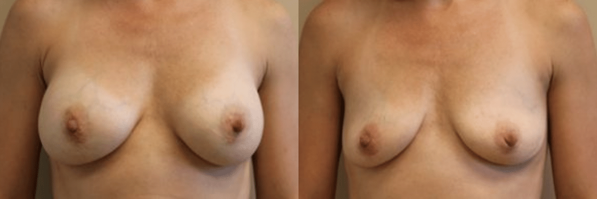 front view before and after breast implant removal