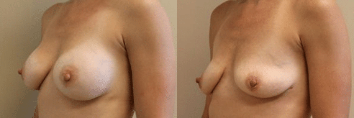side view before and after breast implant removal