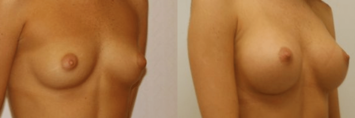 24 year old female before and after 325cc implant breast augmentation side view