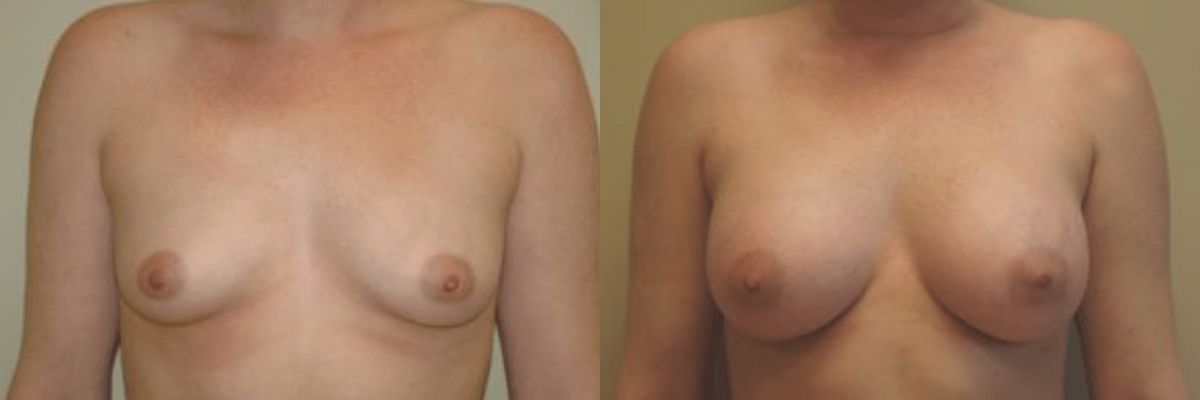 27 year old female before and after 325cc implant breast augmentation front view