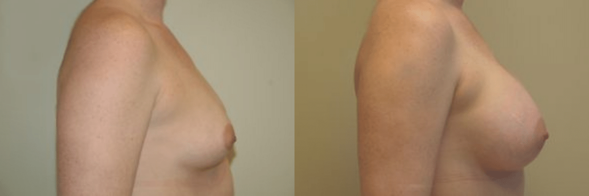 27 year old female before and after 325cc implant breast augmentation side view