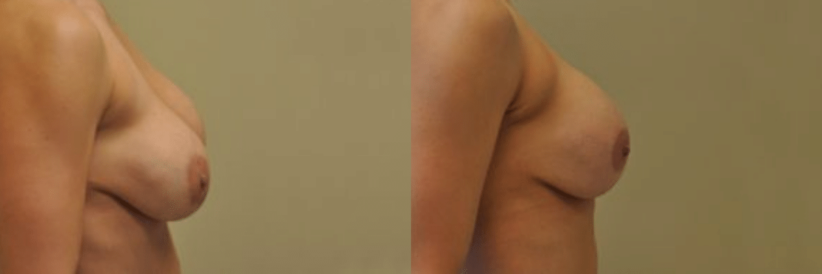 34 year old female before and after breast revision side view