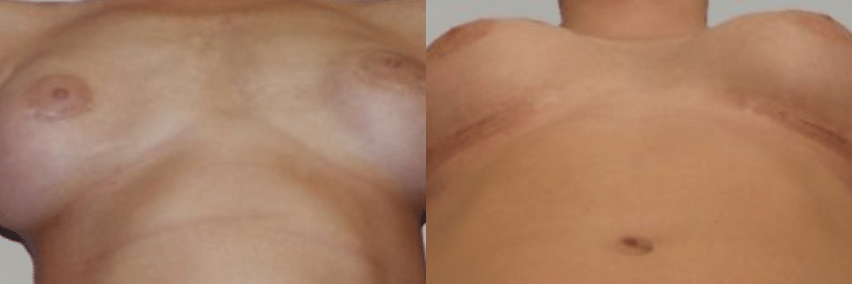 21 year old female patient breast revision before and after laying down