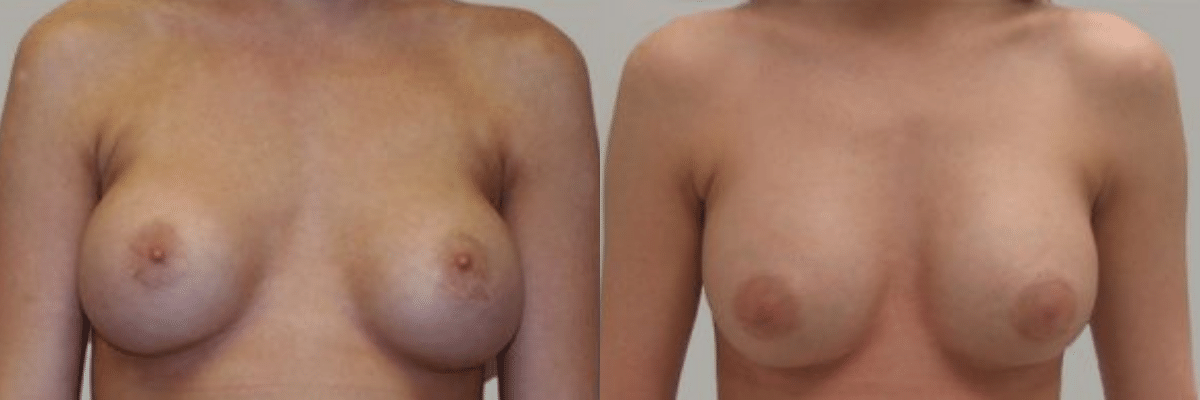21 year old female patient breast revision before and after front view