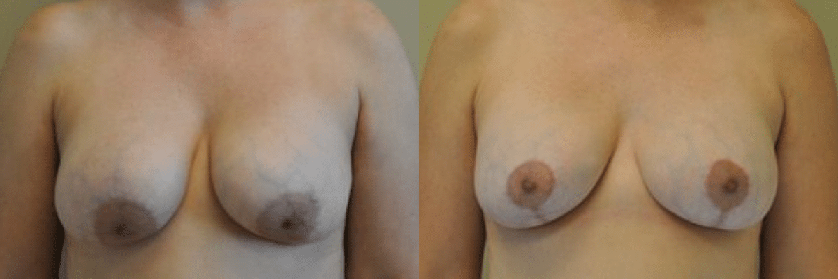 41 year old female patient breast revision front view