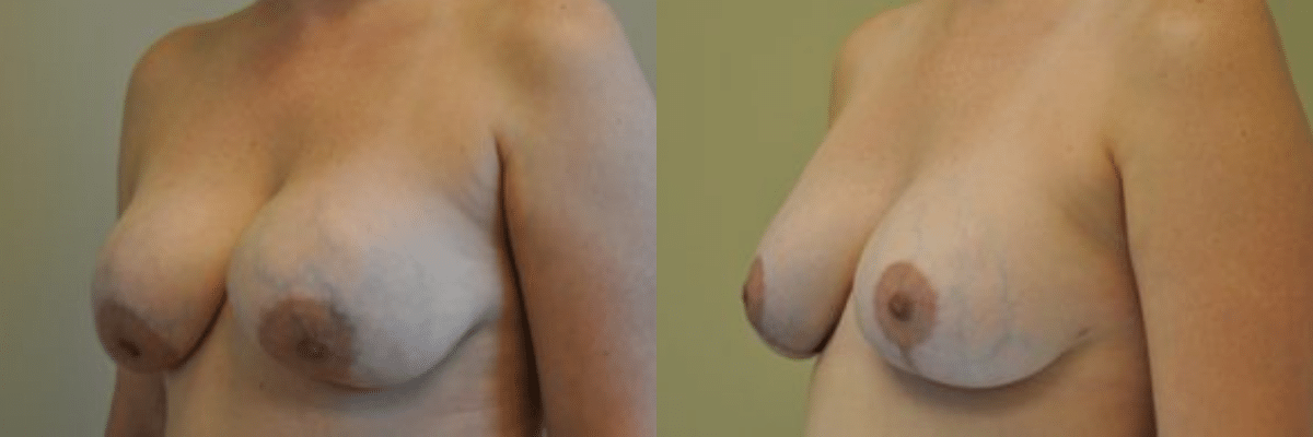 41 year old female patient breast revision side view