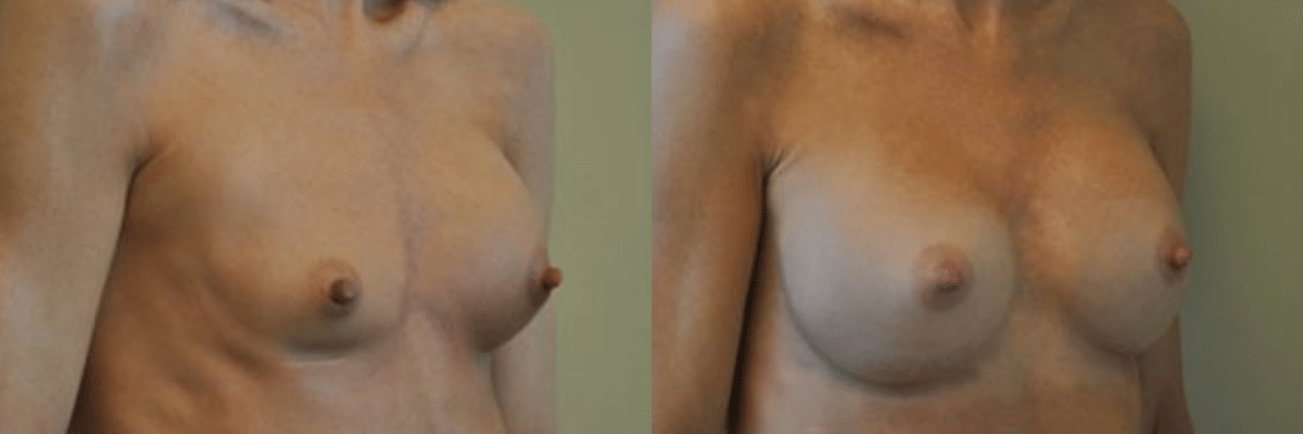 37 year old female patient breast revision front view