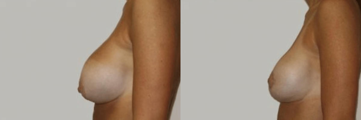44 year old female patient breast revision left side view