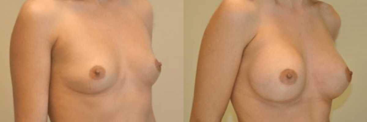 33 year old female before and after 234cc silicone implant breast augmentation side view