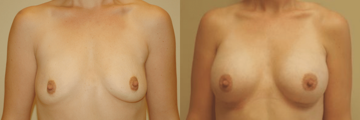 27 year old female before and after 339cc silicone gel implant breast augmentation front view