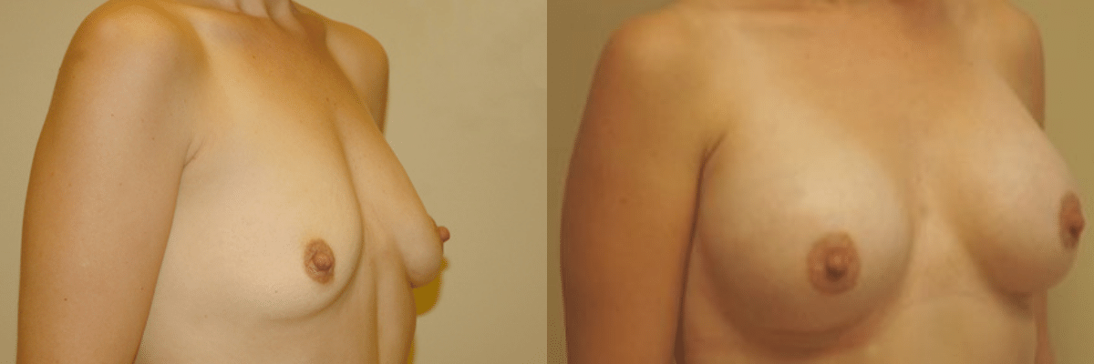 27 year old female before and after 339cc silicone gel implant breast augmentation side view