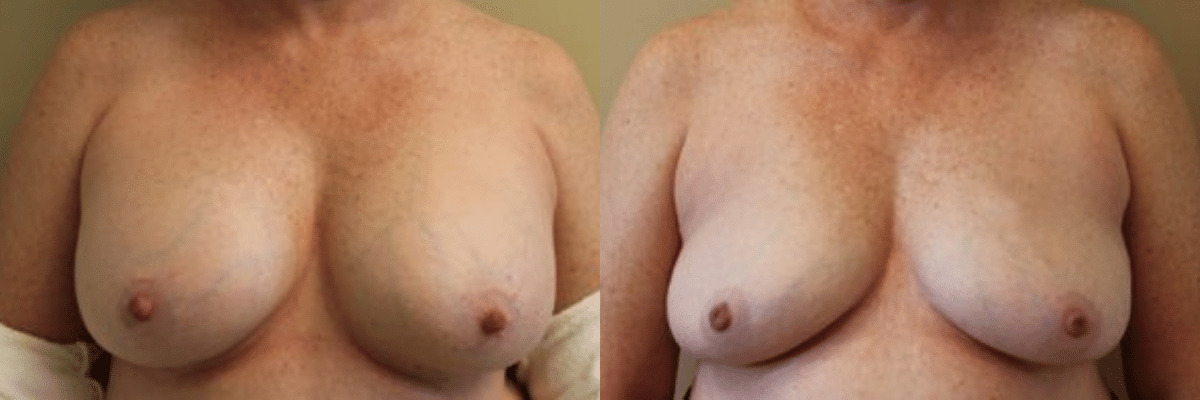 50 year old female before and after 400cc breast implant removal front view