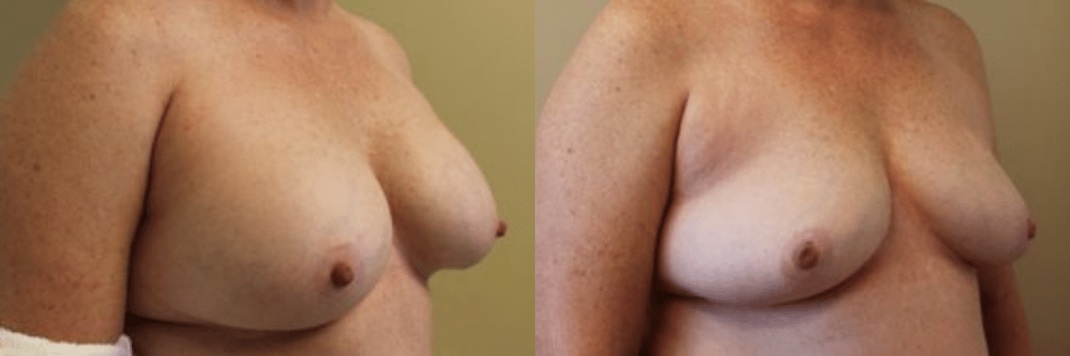 50 year old female before and after 400cc breast implant removal side view