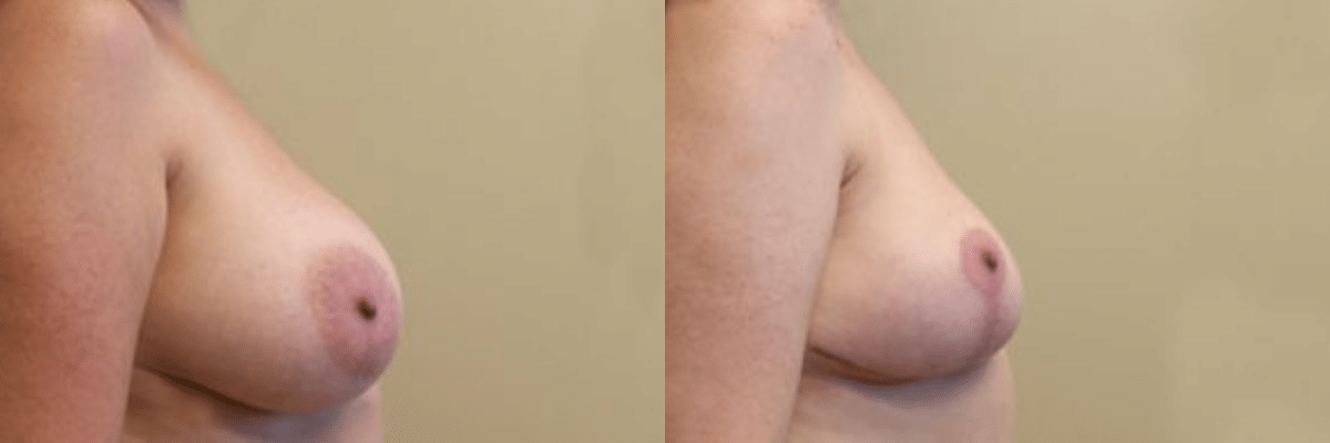 40 year old female before and after 350cc breast implant removal side view