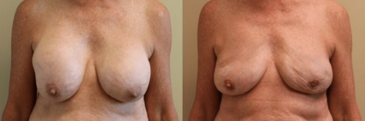 68 year old female before and after capsulectomy front view
