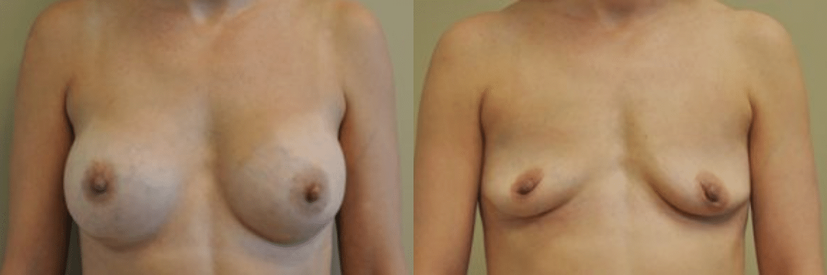 39 year old female before and after 375cc breast implant removal front view 1 month post op
