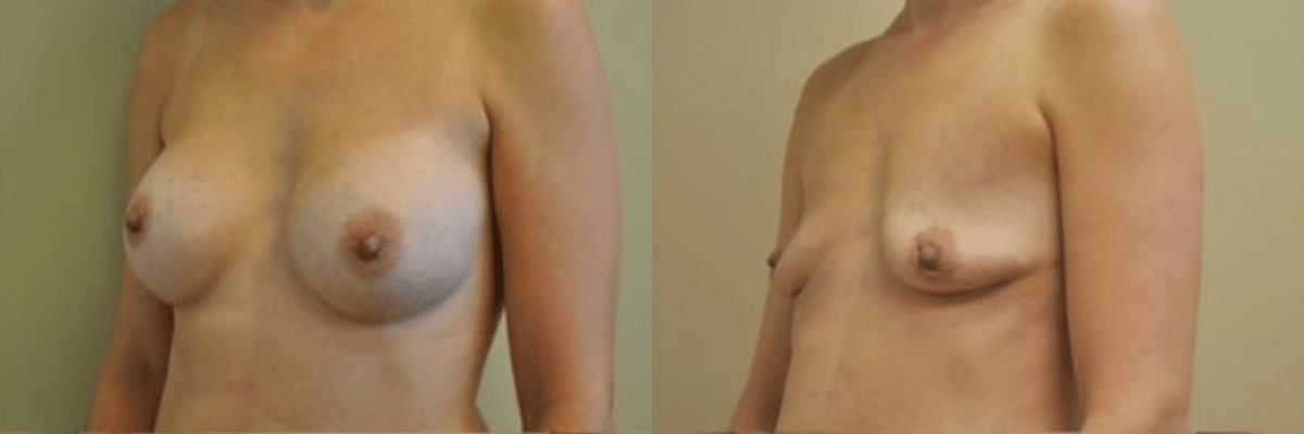 39 year old female before and after 375cc breast implant removal side view 1 month post op