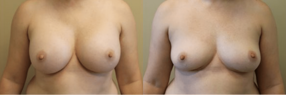 38 year old patient before and after 400cc breast implant removal front view