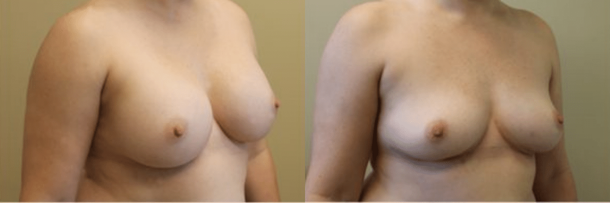 38 year old patient before and after 400cc breast implant removal side view