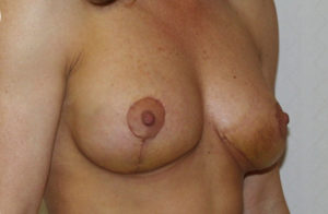 Breast Asymmetry Before and After Photos