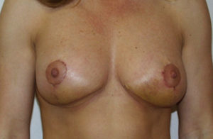 Breast Asymmetry Before and After Photos