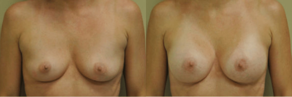 37 year old female before and after 286cc implant breast augmentation front view