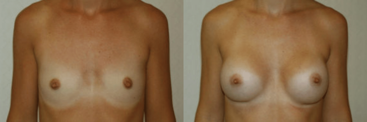 30 year old female before and after 270cc implant breast augmentation front view