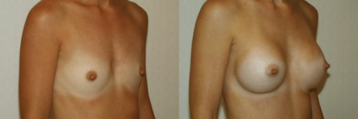 30 year old female before and after 270cc implant breast augmentation side view
