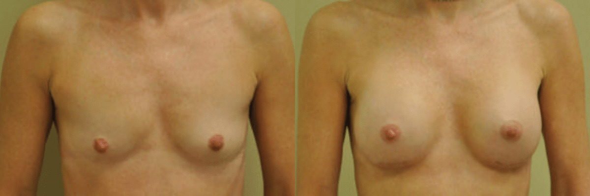 50 year old female before and after 234cc implant breast augmentation front view 5 weeks post op