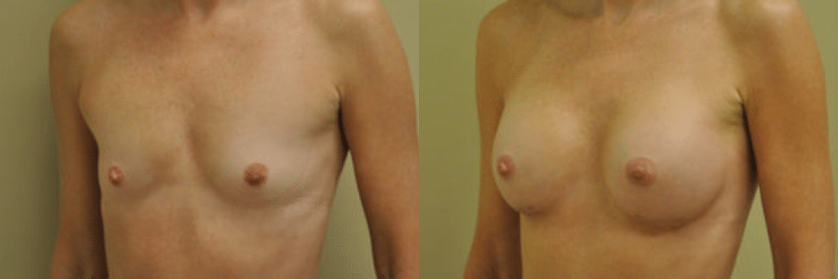 50 year old female before and after 234cc implant breast augmentation side view 5 weeks post op
