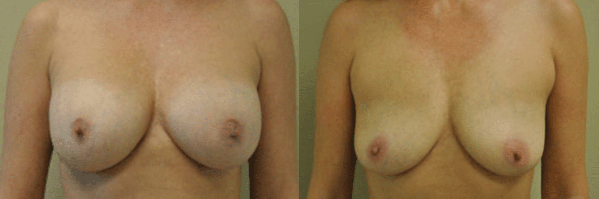 41 year old female before and after 325cc breast implant removal front view
