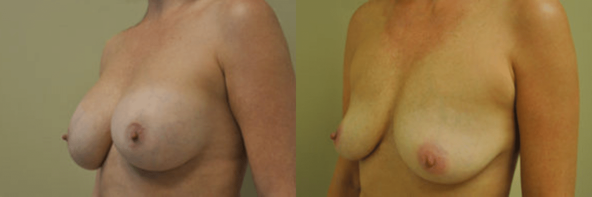 41 year old female before and after 325cc breast implant removal side view