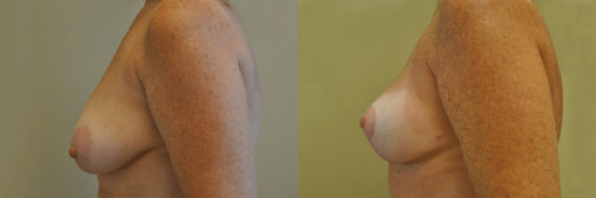 48 year old female 2 months post op before and after breast lift side view