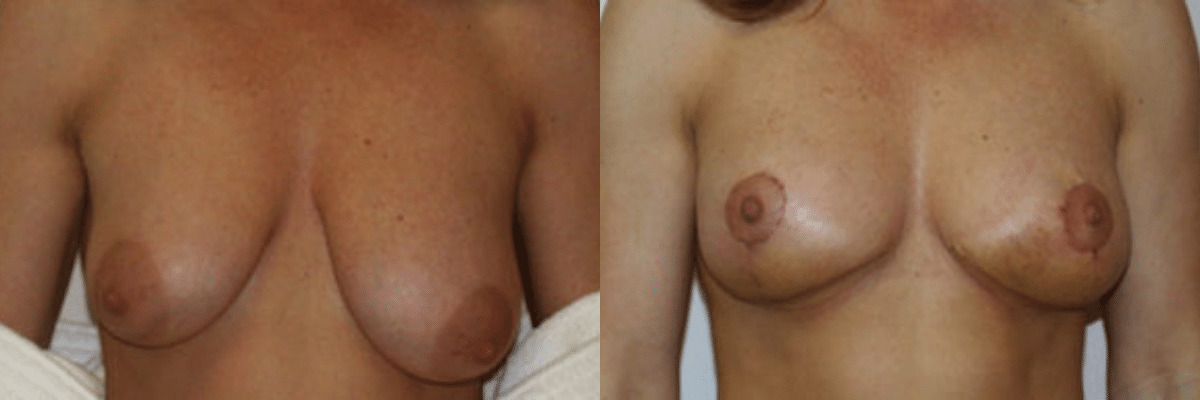 32 year old before and after breast asymmetry and augmentation and reduction surgery front view