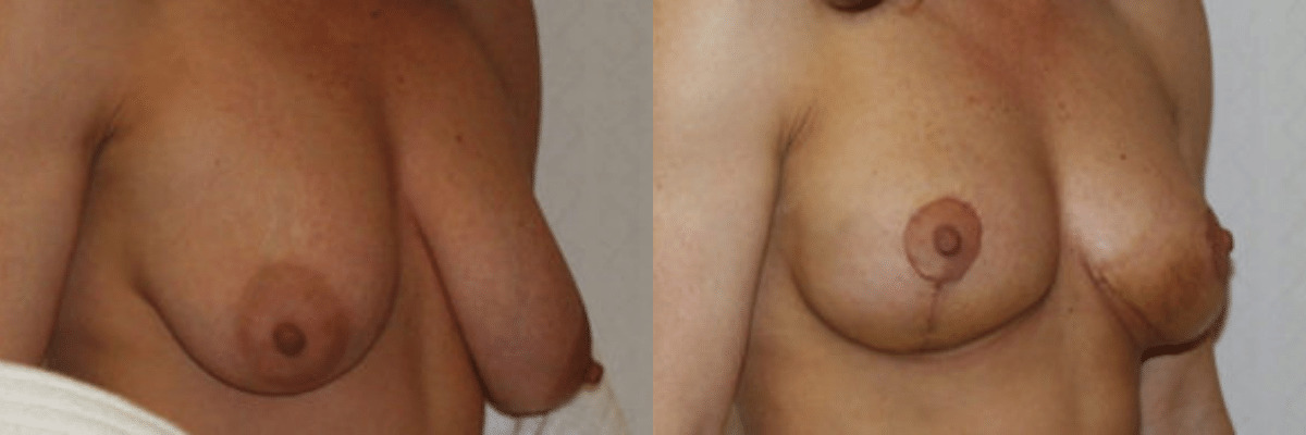 32 year old before and after breast asymmetry and augmentation and reduction surgery side view