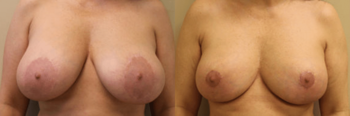 50 year old female before and after 225cc breast implant removal with breast reduction and lift front view